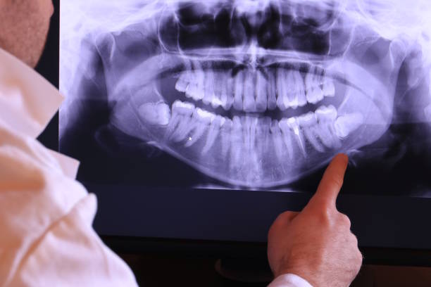 Best Emergency Treatment for Dental Infections or Abscesses in Estero, FL